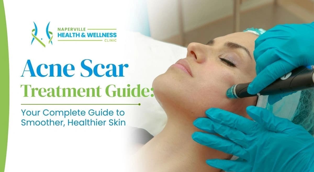 Woman receiving a microneedling treatment on her cheek on a Naperville Health & Wellness Clinic graphic titled "Acne Scar Treatment Guide: Your Complete Guide to Smoother, Healthier Skin."